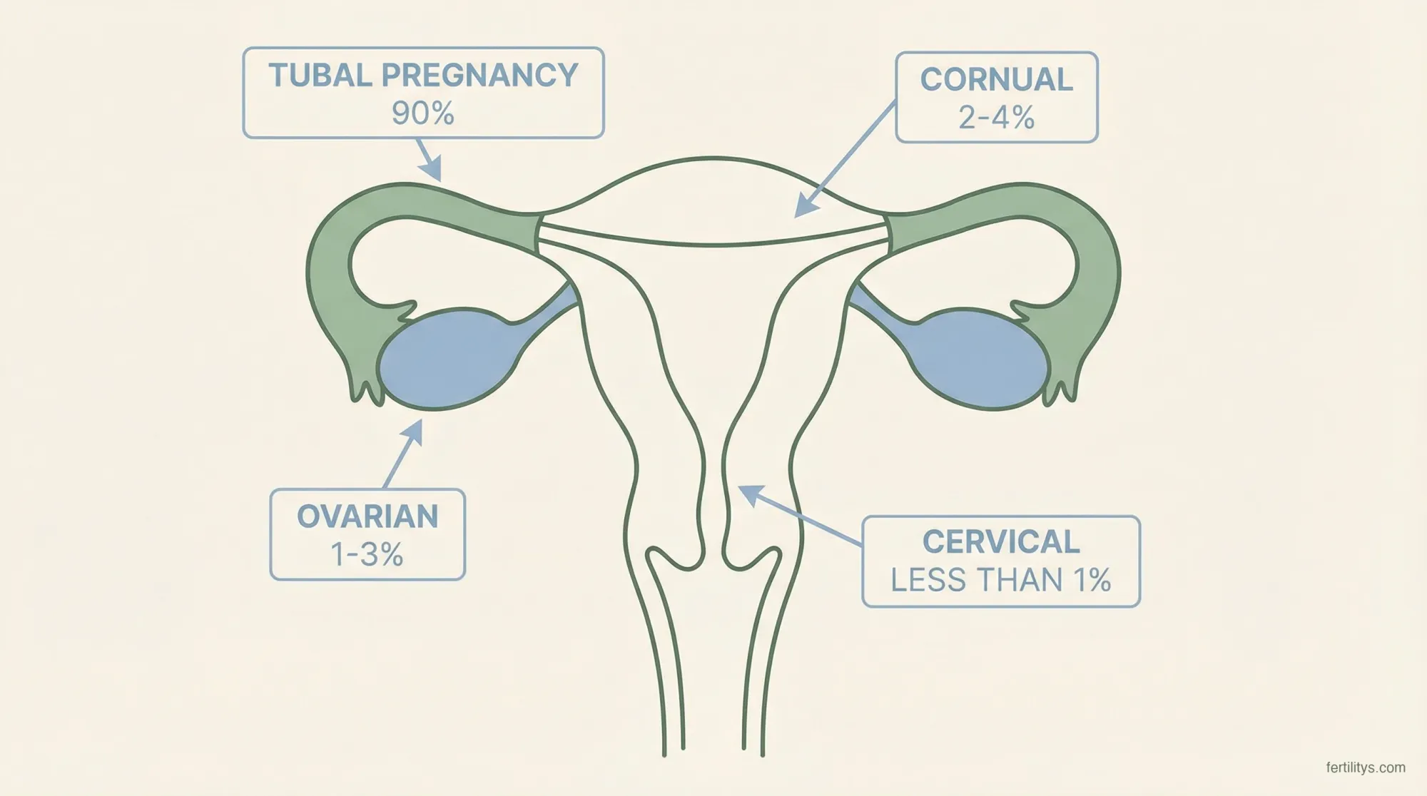 Diagram showing where ectopic pregnancies occur — tubal, ovarian, cervical, and cornual locations with percentages